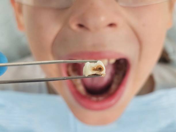 Best Emergency Dentist for Lost Fillings or Crowns in Oquawka, IL